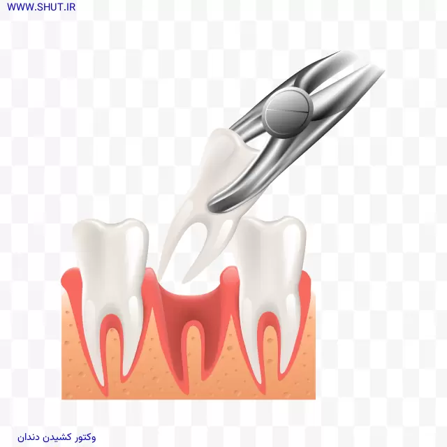 وکتور کشیدن دندان